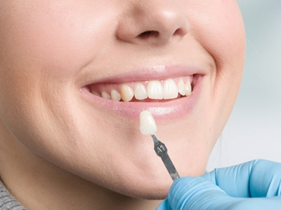 How Much Does Teeth Whitening Cost? A Complete Guide